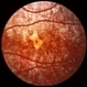 Rubella Retinopathy